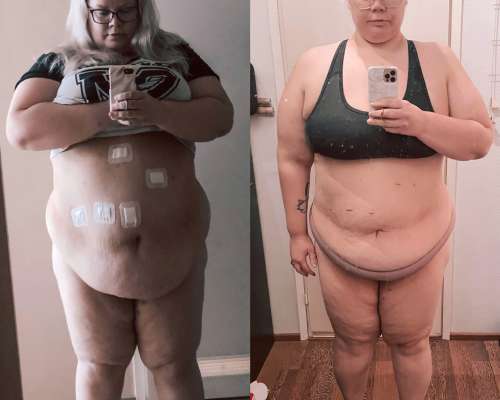 12 viikkoa lihavuusleikkauksesta ja -30kg