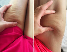 How to reduce cellulite narutally? see my results.