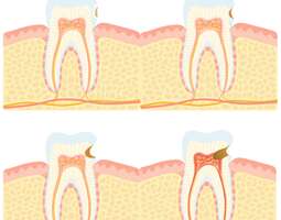 Tooth patching is a multi-stage process. / Ha...