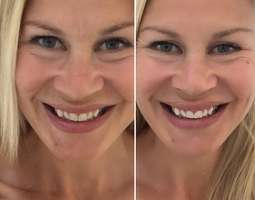 Hampaiden valkaisu – Miten hymyn kävi?