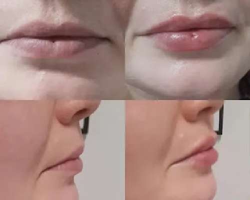Ennen ja jälkeen huulten täytön