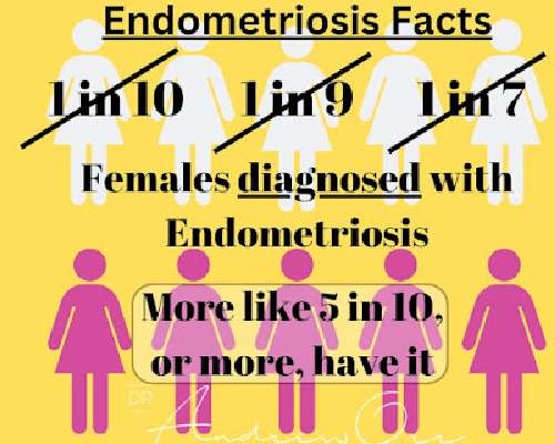 Onko endometrioosi luultua yleisempää?