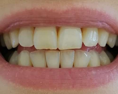 Soodapuhdistus ja hammaskorut