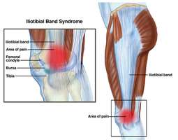 Running injuries: knee pain