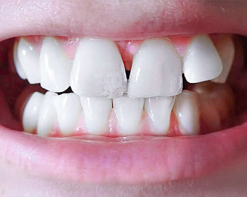 Hymy uusiksi: hammaslaminaatit // dental veneers
