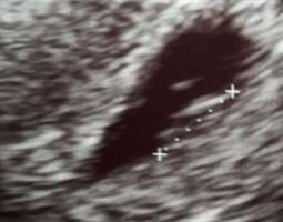 Ensimmäiset raskausviikot kaunistelematta 8-13rv
