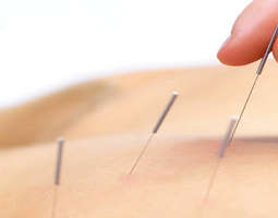 I love akupunktur